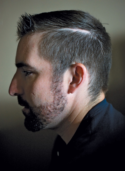 The scar along retired corporal Bruce Moncur’s part line is now barely distinguishable, but the wound that caused it cost five per cent of his brain—and changed his life forever. [LOUIE PALU]